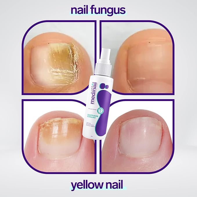 Jaysuin Nail Fungus Spray 100ml