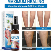 Miracle Veins Spray